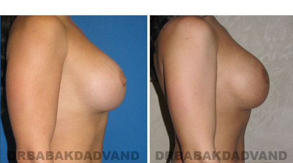 Before and After Photos |Revision Breast| 28 year old female,, - right side view