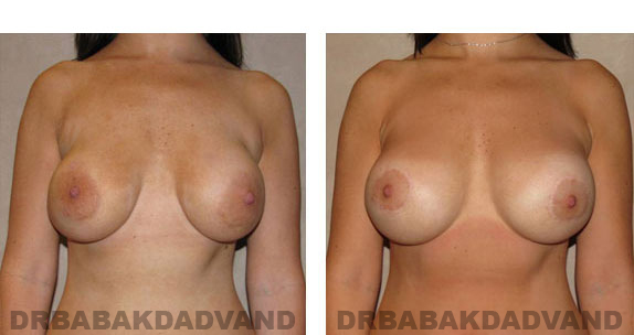 Before and After Photos |Revision Breast| - 32 year old female, - front view