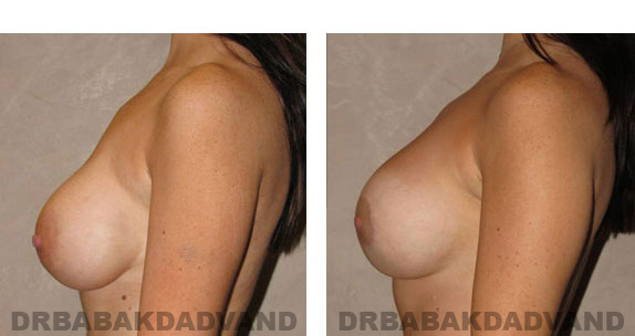 Before and After Photos |Revision Breast| - 32 year old female, - left side view
