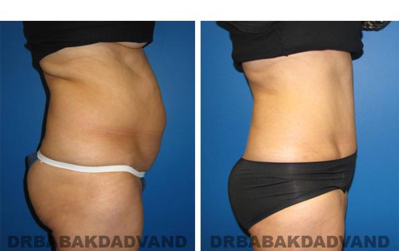 Before and After Photos |Tummy Tuck| 57 year old female, - right side view