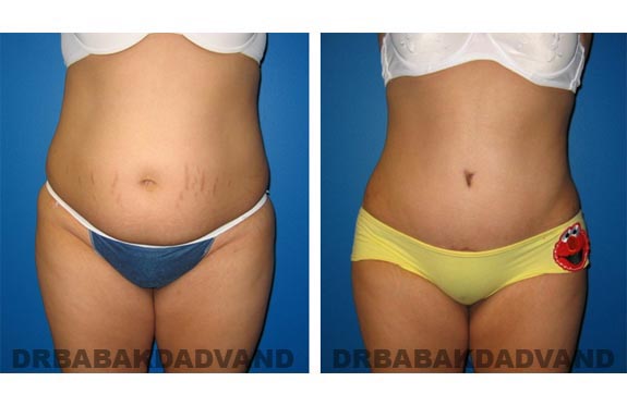 Before and After Photos |Tummy Tuck| 22 year old female, - front view
