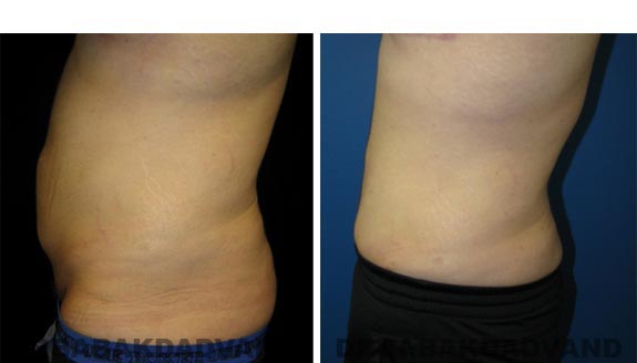 Before and After Photos |Tummy Tuck| 26 year old male, - left side view