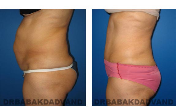 Before and After Photos |Tummy Tuck| 59 year old female, - left side view