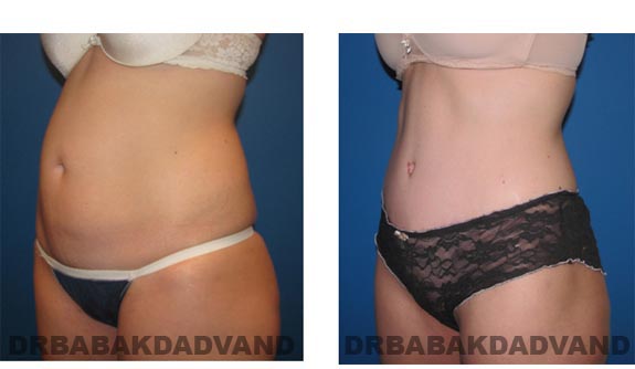 Before and After Photos |Tummy Tuck| 35 year old woman, - left side, oblique view