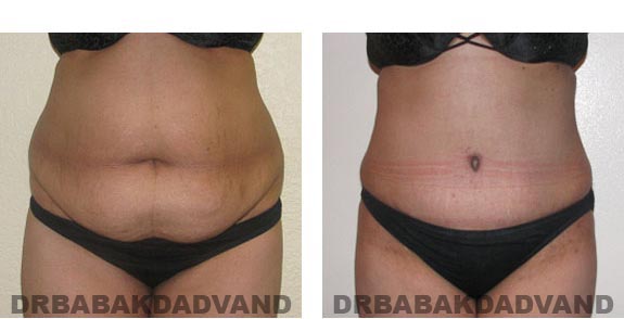 Before and After Photos |Tummy Tuck| 33 year old woman, - front view
