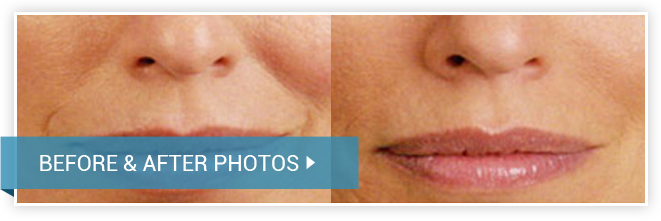 Juvederm. Before and After photos female front view