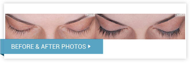LATISSE™ Eyelash Enhancer. Before and After photos female front view