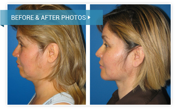 Necklifts. Before and After photos female left side view