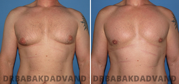 Before and After Photos. Gynecomastia.