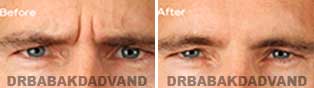 Botox: Before and After Photos male front view