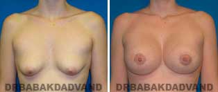 Breast Lift. Before and After Photos. 22 year old woman - front view