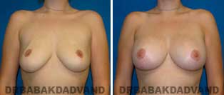 Breast Lift. Before and After Photos. 24 year old woman - front view