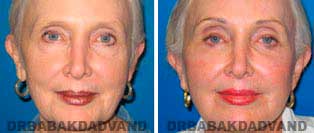 Browlift: Before and After Photos - 67 year old female, front view