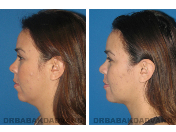 Before - After Photos |Chin Augmentation| female, left side view