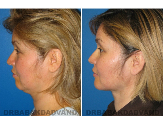 Before - After Photos |Chin Augmentation| woman, left side view