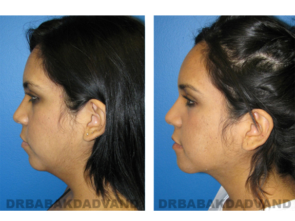 Before and After Photos |Chin Augmentation| woman, left side view