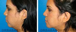 Chin Augmentation: Before and After Photos - woman, left side view