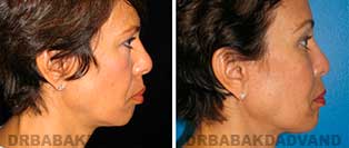 Chin Augmentation: Before and After Photos - woman, right side view