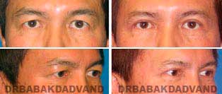 Eyelid: Before and After Photos - 57 year old male, front view (oblique view)