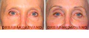 Eyelid: Before and After Photos - 67 year old female, front view