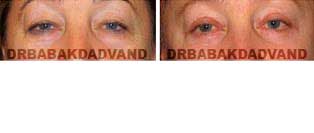 Eyelid: Before and After Photos - 56 year old female, front view