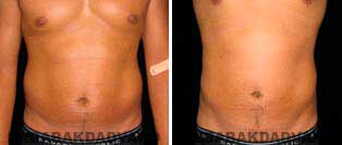 Liposuction: Before and After Photos - 32 year old male - front view