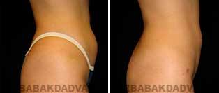 Liposuction: Before and After Photos - 33 year old female - right side view