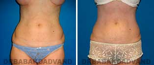 Liposuction: Before and After Photos - 47 year old female - front view