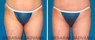 Liposuction: Before and After Photos - 34 year old female - front view
