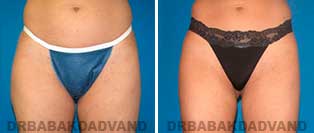 Liposuction: Before and After Photos - 32 year old female - front view
