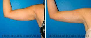 Liposuction: Before and After Photos - 26 year old female - front view(liposuction of her arms)