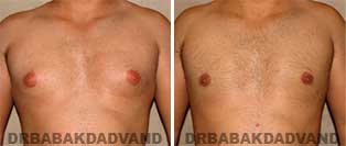Breast Before & After Photos. Male Breast reduction