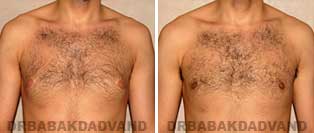 Gynecomastia. Before and After Photos. 24 year old man - front view