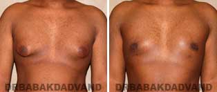 Gynecomastia. Before and After Photos. 22 year old man - front view