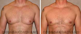 Gynecomastia. Before & After Photos. 39 year old man - front view