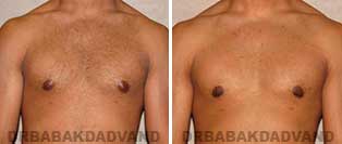 Gynecomastia. Before & After Photos. 23 year old man - front view