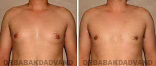 Before and After Photos. Gynecomastia. 27 year old. Man - front view