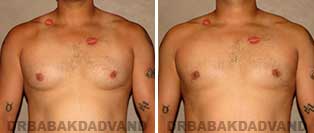 Before and After Photos. Gynecomastia. 34 year old. Man - front view