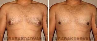 Before and After Photos. Gynecomastia. 28 year old. Man - front view