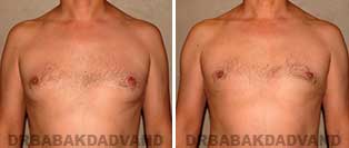 Before and After Photos. Gynecomastia. 40 year old. Man - front view