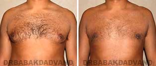 Before and After Photos. Gynecomastia. 33 year old. Man - front view