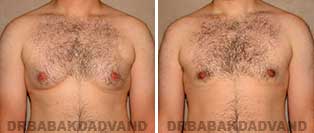 Before and After Photos. Gynecomastia. 26 year old. Man - front view