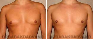 Before and After Photos. Gynecomastia. 29 year old. Man - front view