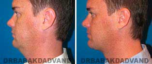 Necklift: Before and After Photos - 37 year old male, left side view
