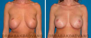 Revision Breast. Before and After Photos. 27 year old woman - front view