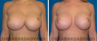 Revision Breast. Before and After Photos. 23 year old woman - front view