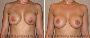 Revision Breast. Before and After Photos. 25 year old woman - front view