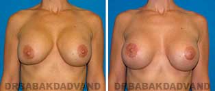 Revision Breast. Before and After Photos. 42 year old woman - front view