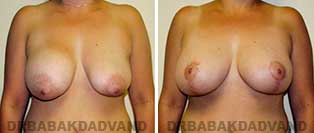 Revision Breast. Before and After Photos. 41 year old woman - front view