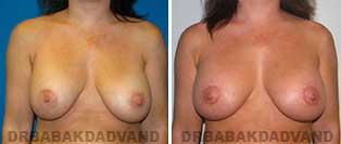Revision Breast. Before & After Photos. 40 year old woman - front view